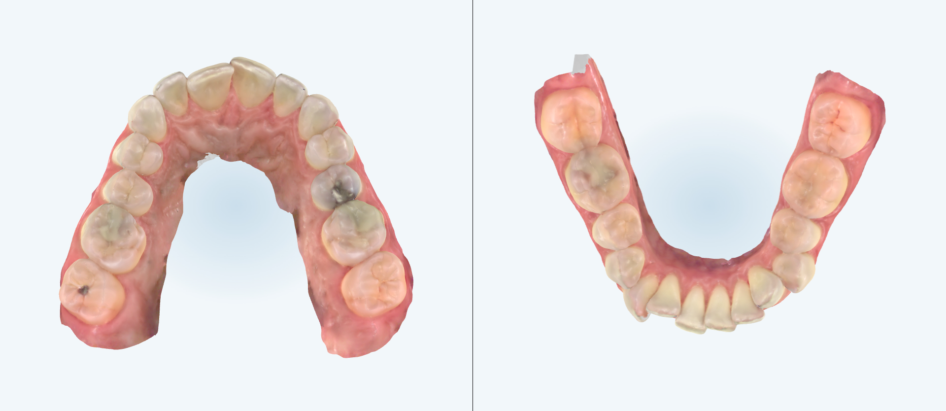 Dental expansion treatment comparison case 3 before
